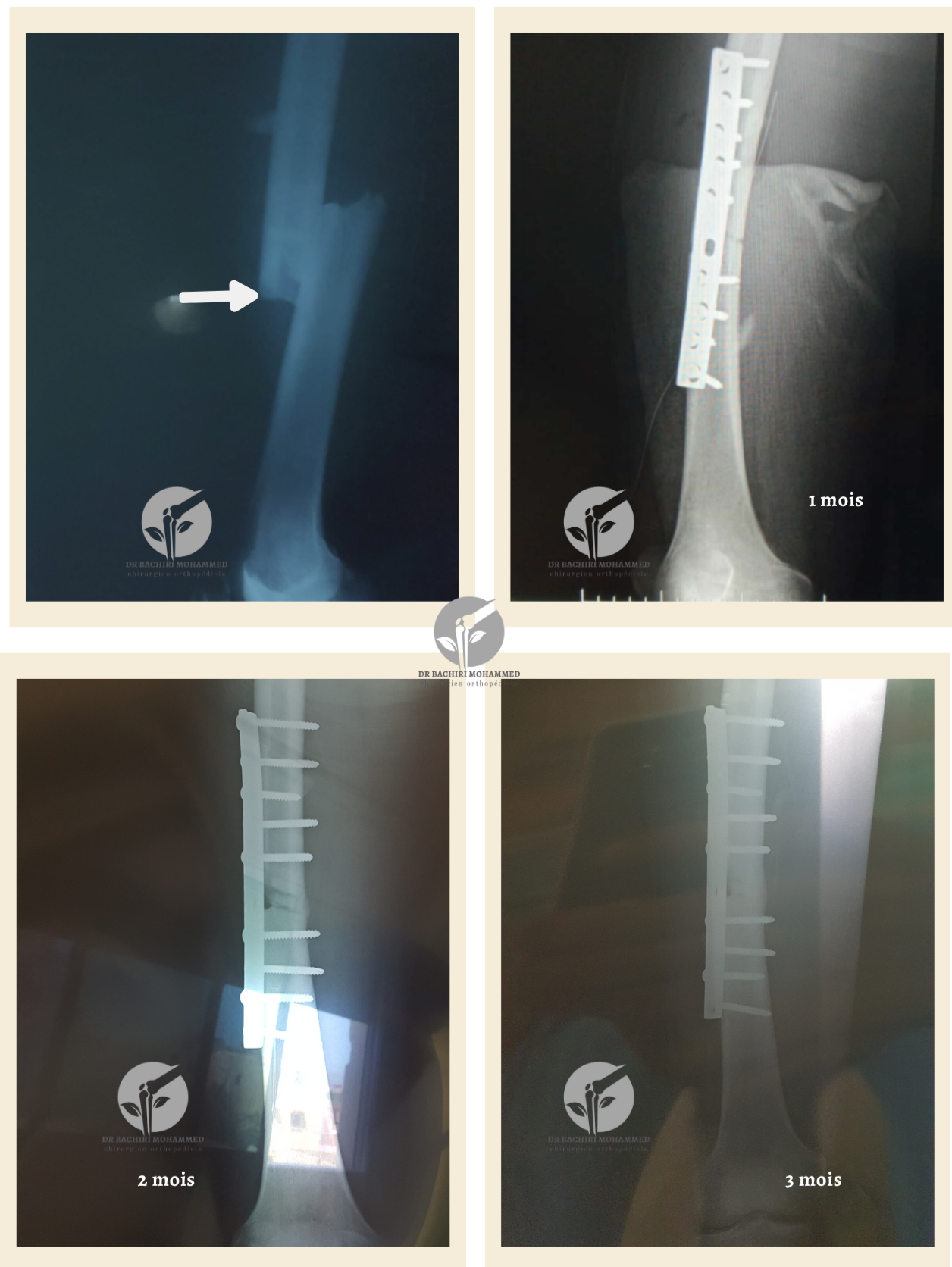 Fracture du fémur avec plaque vissée par Dr. Bachiri Mohammed à Oujda